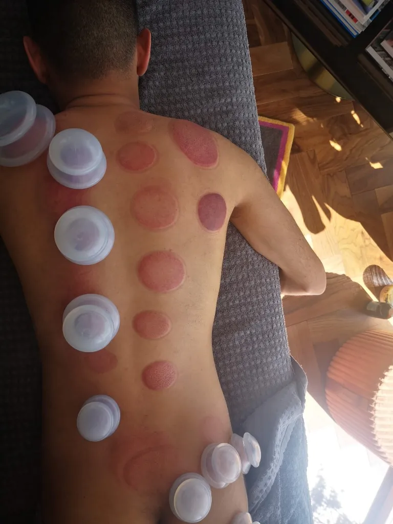 Cupping therapy for fascial release at Mayfair Massage and Therapy clinic